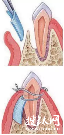 點擊查看原圖 引導性骨再生