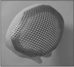 三維數字化成形鈦網修復體照片